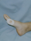 ADHESIVE BUNION PROTECTOR PADS.