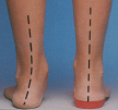 POSSITION OF HEEL IN A FOOT WITH SEVERE EXCESS PRONATION.