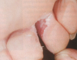 ATHLETES FOOT BETWEEN THE TOES.