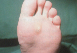 VERRUCA ON THE SOLE OF THE FOOT.